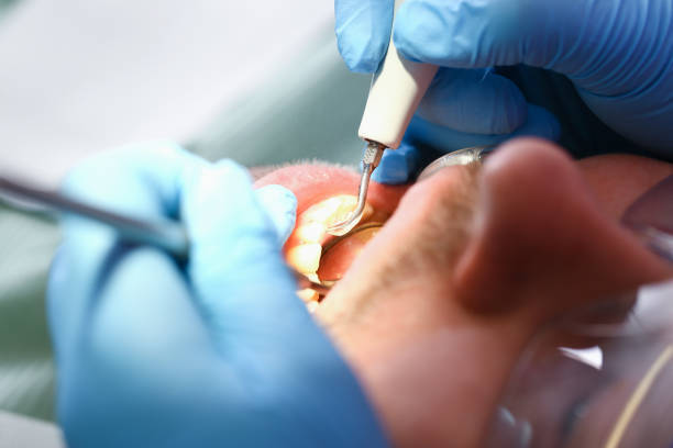 Best Emergency Dentist for Lost Fillings or Crowns in Cassopolis, MI